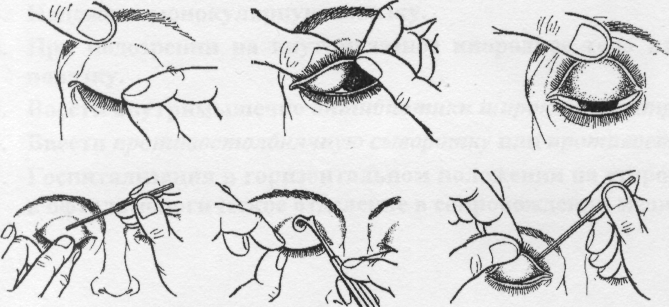 Электроофтальмия: лечение повреждения роговицы глаза, чем лечить ожог глаз от сварки, капли - medside.ru