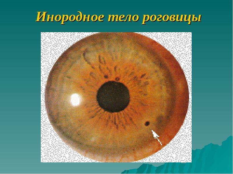 Травма глаза - первая помощь, последствия, лечение в домашних условиях